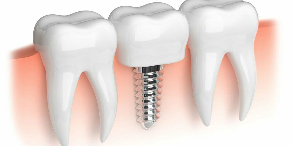 Implantaciya-zubov