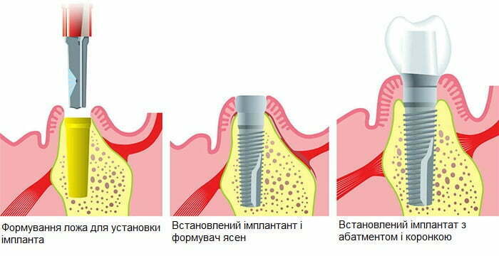 Етапи імплантації зубів